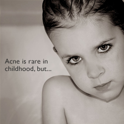 child-acne-01