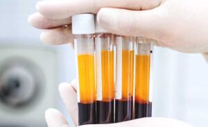 PRP (Platelet-Rich Plasma)